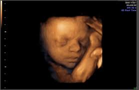 26 weeks pregnant with twins. Pregnancy Week 26