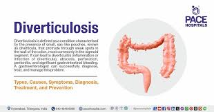 Image result for Diverticulitis