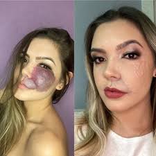 Jovem passa por transplante de pele para corrigir malformação no rosto