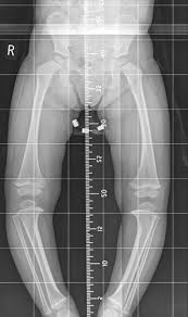 Image result for Genu Varum