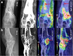 Image result for Osteomyelitis