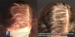 The amount of hair loss experienced by people with alopecia areata varies. Hair Loss Treatments Near Me New Jersey Thinning Hair Price Cost