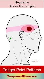 Pin On Headaches Cervicogenic