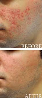 Evolving indicators suggest a connection between gut health and hair growth that remains to be proven. Acne And Rosacea Bopp Dermatology Facial Plastic Surgery