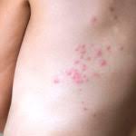 Generally, bed bug bites do not require medication as these are known to be painless, but the discomfort and itchiness caused by these parasites bed bug bites on the baby's face and on the body may lead to a lot of irritation. How To Handle Bed Bugs And Their Bites Health Essentials From Cleveland Clinic