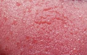 How To Get Rid Of Swollen Taste Buds Ehow Inflamed Taste Buds Bumps On Tongue Tongue Taste Buds