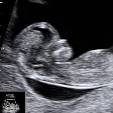 Nipt Non Invasive Prenatal Test Harmony Test Down Syndrome Test