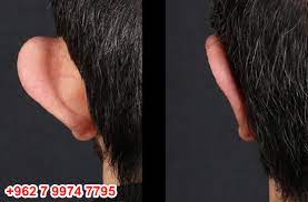 عملية تجميل الاذن يعتبر نمو الأذن بشكل غير طبيعي من أكثر أشكال التشوه الموجود في نمو الغضاريف والذي يجعل الأذن بعيده ع long hair styles implants hair styles