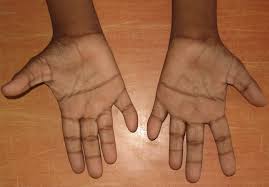 Check spelling or type a new query. Phenotypic And Dermatological Manifestations In Down Syndrome