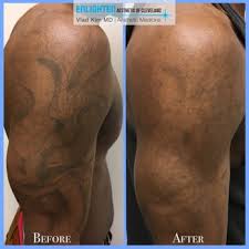 It's highly advisable to see a dermatologist to discuss your options but some possibilities for tattoo removal include: Dark Skin Laser Tattoo Removal Before And After