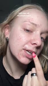 Peach Slices Acne Pimple Patch Removal and Review