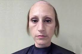 It's a slow progressive loss, steixner explains. Breast Cancer Survivor Files Permanent Hair Loss Lawsuit