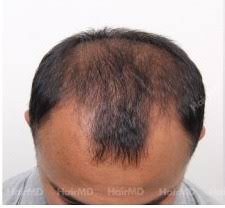 Hair shedding, hair thinning and hair breakage. Frontal Baldness Causes Treatments Hairmd Pune