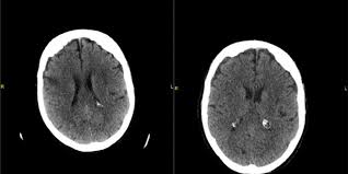 No Todo Es Culpa De La Anestesia Neumoencefalo Vs Ictus Tras Anestesia Neuroaxial Anestesiar