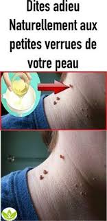 Comment Faire Pour Eliminez Rapidement Les Petites Verrues De Votre Peau En Utilisant Un Seul Ingredient Health Good To Know Cancer