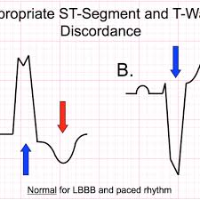 Large Block Method To Calculate Heart Rate Ecg Medical