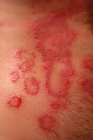 Sensitive individuals may experience dermatitis—skin inflammation and irritation commonly referred to as eczema. Kortison Allergie Symptome Ursachen Und Tipps Fur Allergiker