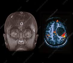 Image result for Brain Lesion