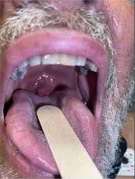 Image result for Uvulitis