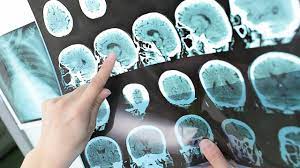 Living with multiple sclerosis (ms) is a condition that can affect the brain and spinal cord, causing a wide range of potential symptoms, including problems with vision, arm or leg movement, sensation or balance. Ce Declanseaza Scleroza Multipla Youtube