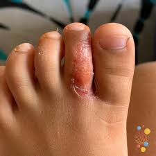 Image result for Impetigo