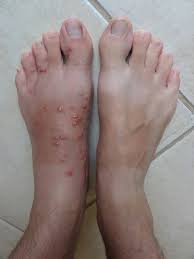 Parce qu'il fait chaud en été et qu'il y a la prolifération des insectes qui si certaines démangeaisons sont causées par des pathologies, d'autres le sont suite à des allergies ou à des piqûres de moustiques. Apaiser Une Piqure D Insecte Solutions Naturelles