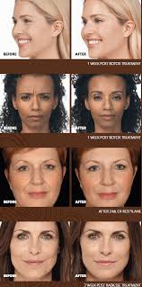 Brilliant distinctions gift cards can be used in vedas on allergan products like botox, and juvederm, kybella and coolsculpting. Botox Dermal Fillers Ashburn Reston Leesburg Va