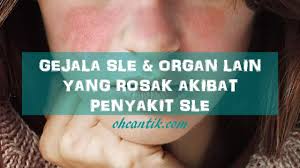 Sakit mata kebiasaannya menyebabkan mata merah, pedih, bengkak dan bertahi. Penyakit Sle Organ Lain Yang Turut Rosak Ohcantik Com
