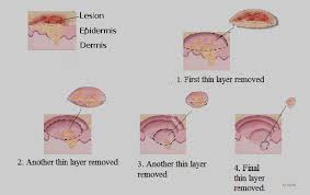 That rash can ultimately transform into tumors and malignant cells can spread to other. Treatment Of Skin Cancer By Surgery Download Scientific Diagram