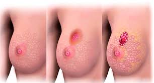 Breast cancer — Steemit