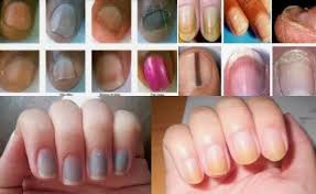 Pertumbuhan jamur di kuku juga bisa diturunkan dalam keluarga. 5 Perubahan Warna Kuku Yang Bisa Jadi Sinyal Atau Tanda Penyakit Berita Viral