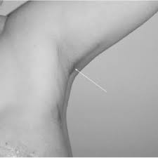 Axillary Web Syndrome After Sentinel Lymph Node Biopsy Download Scientific Diagram