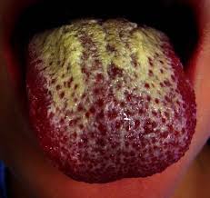 Image result for Candidiasis