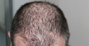 However, if there are patches of hair falling out of your beard or other areas, you might have a more serious type of alopecia. Having Men Hair Loss Issues Learn How To Get Your Hair Back With These Hair Loss Tips