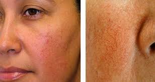 Every Woman Dreams Of Having Healthy And Smooth Skin Unfortunately Skin Conditions Such As Couperosis And Rosace Natural Acne Cures Red Face Remedies Rosacea