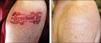The cost of laser tattoo removal depends on the size, color, and age of your tattoo. Aftercare Instructions For Removing A Red Tattoo Natural Tattoo Removal Tattoo Removal Red Tattoos