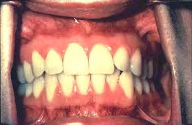 Espacio en forma de herradura limitado por los labios y las mejillas en su pared anterolateral y por lo arcos alveolodentario