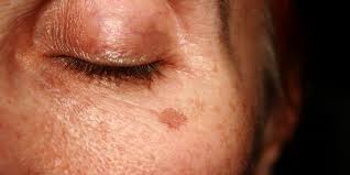 We did not find results for: How To Get Rid Of Age Spots Fast 7 Treatments That Work