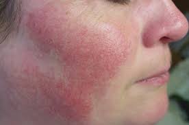 We did not find results for: Couperose Was Hilft Gegen Lastige Rote Aderchen