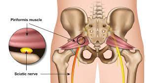 Sciatica Ask The Experts Peninsula Acupuncture