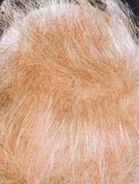 An update on the changing the rise and fall of primary hyperparathyroidism: Hair Loss In Women With Hyperandrogenism Four Cases Responding To Finasteride Journal Of The American Academy Of Dermatology