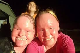 Woman whose skin grew too fast for her body was an 'inspiration'