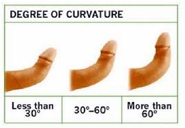 Image result for Chordee