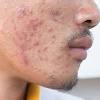 Jerawat paling berkesan, ubat tidur paling berkesan, ubat panau yang berkesan, ubat jeragat paling berkesan, ubat kurus berkesan, ubat kurus yang paling berkesan ubat penyakit kulit renoskin medic serum ubat bebas via www.mwa.my. 1