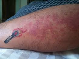 Arm Birthmark Cover Up Tattoo I Ve Had What S Called A Port Wine Stain It S A Bright Red Portion Of Skin That Subjected Me To Cruelness And Curiosit Cover Tattoo Birthmark Tattoo Birthmark