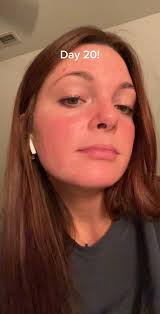 Severe Breaking Out 1st Month of Accutane