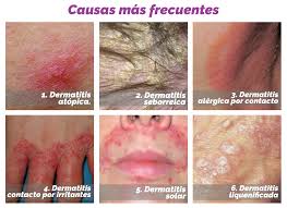 Image result for dermatitis contacta