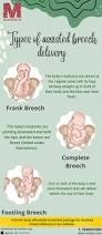 Image result for Breech Delivery