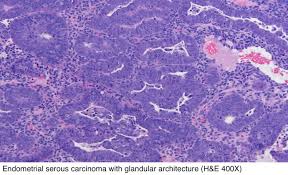 Endometrial polyps are benign nodular protrusions of the endometrial surface, and one of the entities included in a differential of endometrial thickening. Pathology Outlines Serous Carcinoma