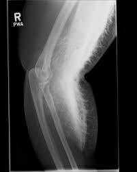 Image result for CT Intravenous Contrast